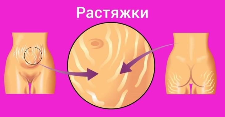 Куда делись растяжки? Копеечное средство из аптеки сделало кожу божественной kuda-delis-rastyazhki-kopeechnoe-sredstvo-iz-apteki-sdelalo-kozhu-bozhestvennoy-2-1530605